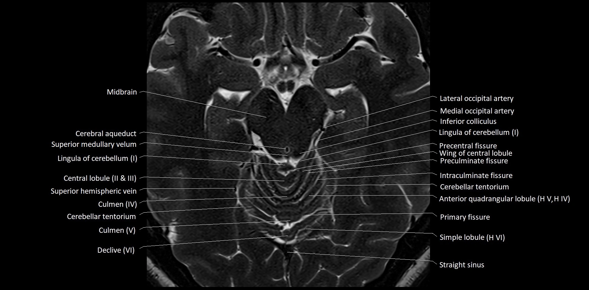 MRI Cerebellar anatomy High-resolution labelled 3T MRI image 24.webp